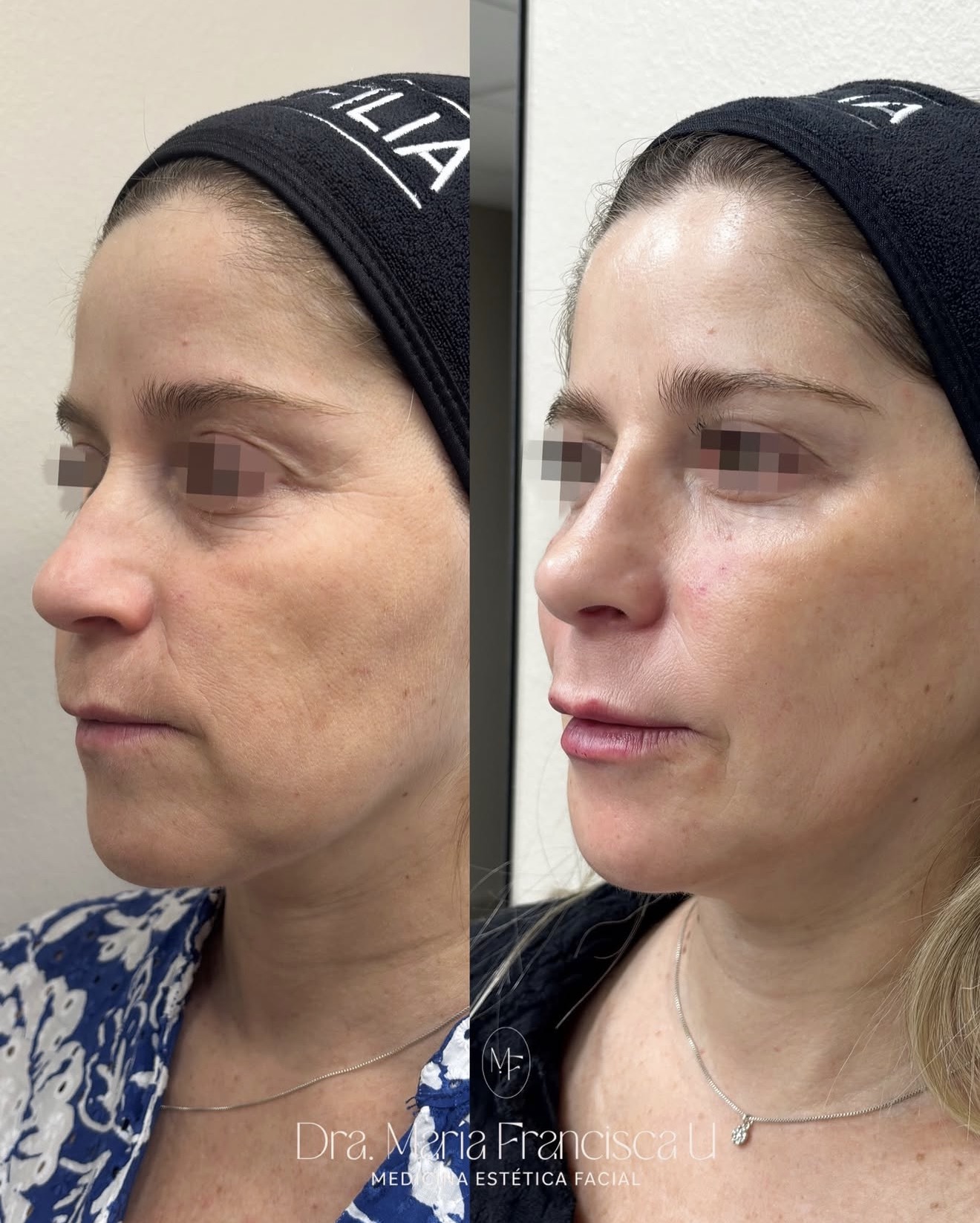 Antes y después de relleno de pómulos y ojeras con ácido hialurónico · Dra. María-Francisca Ulloa
