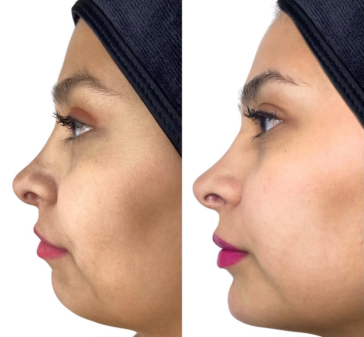 Antes y después de aumento de labios y mentón · perfil lateral · Dra. María-Francisca Ulloa