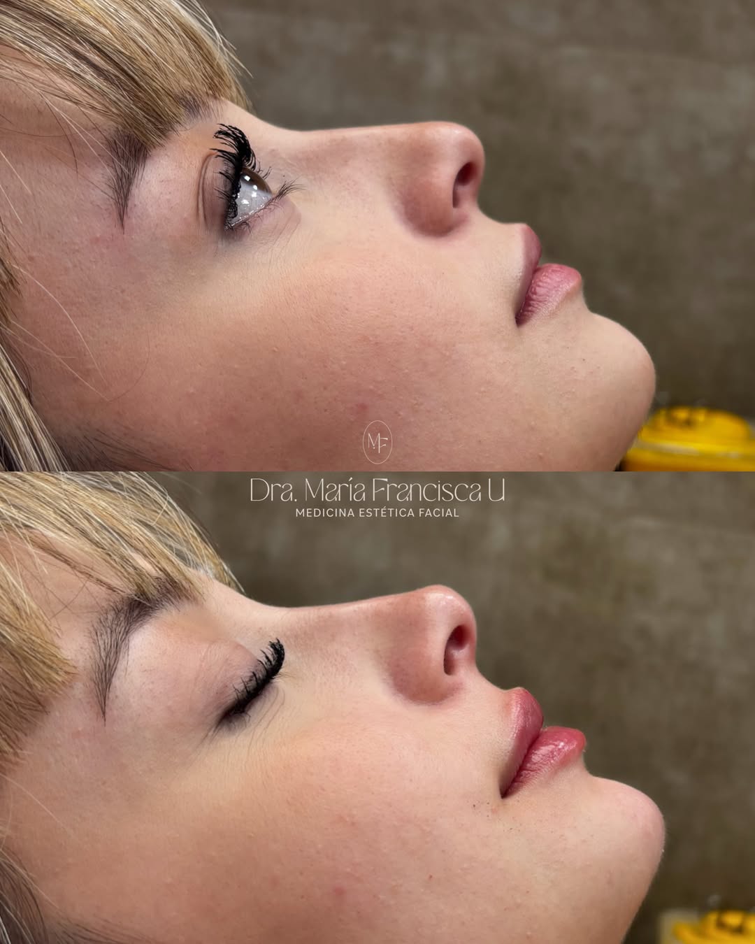 Antes y después de perfiloplastia con la Dra. María-Francisca Ulloa