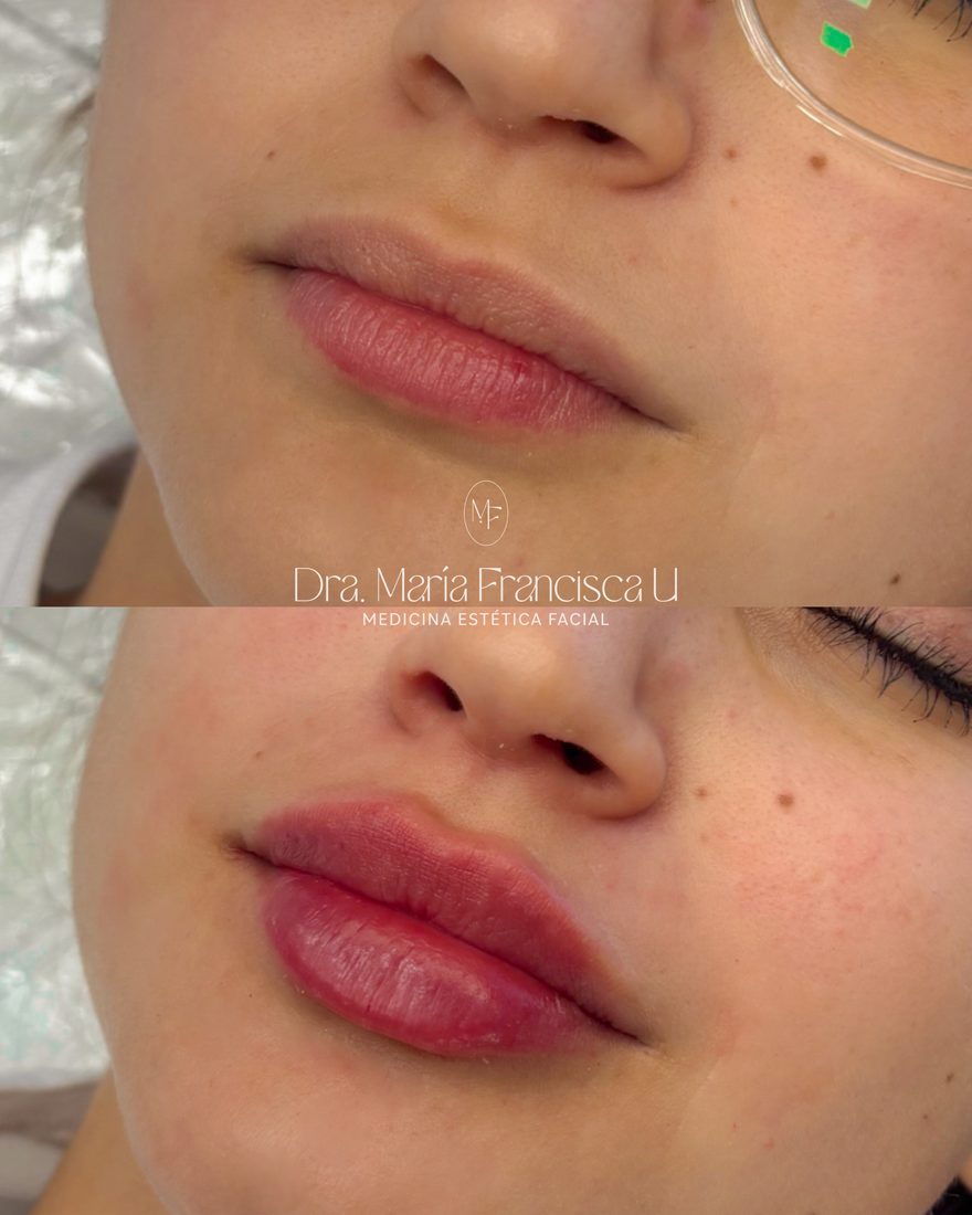 Antes y después de aumento de labios con la Dra. María-Francisca Ulloa