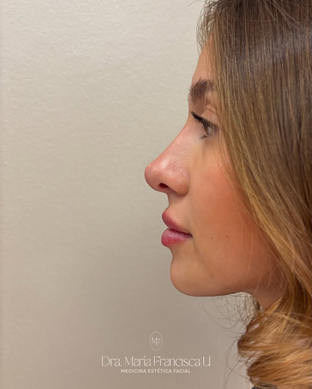 Resultado de Rinolips: rinomodelación y aumento de labios · Dra. María-Francisca Ulloa