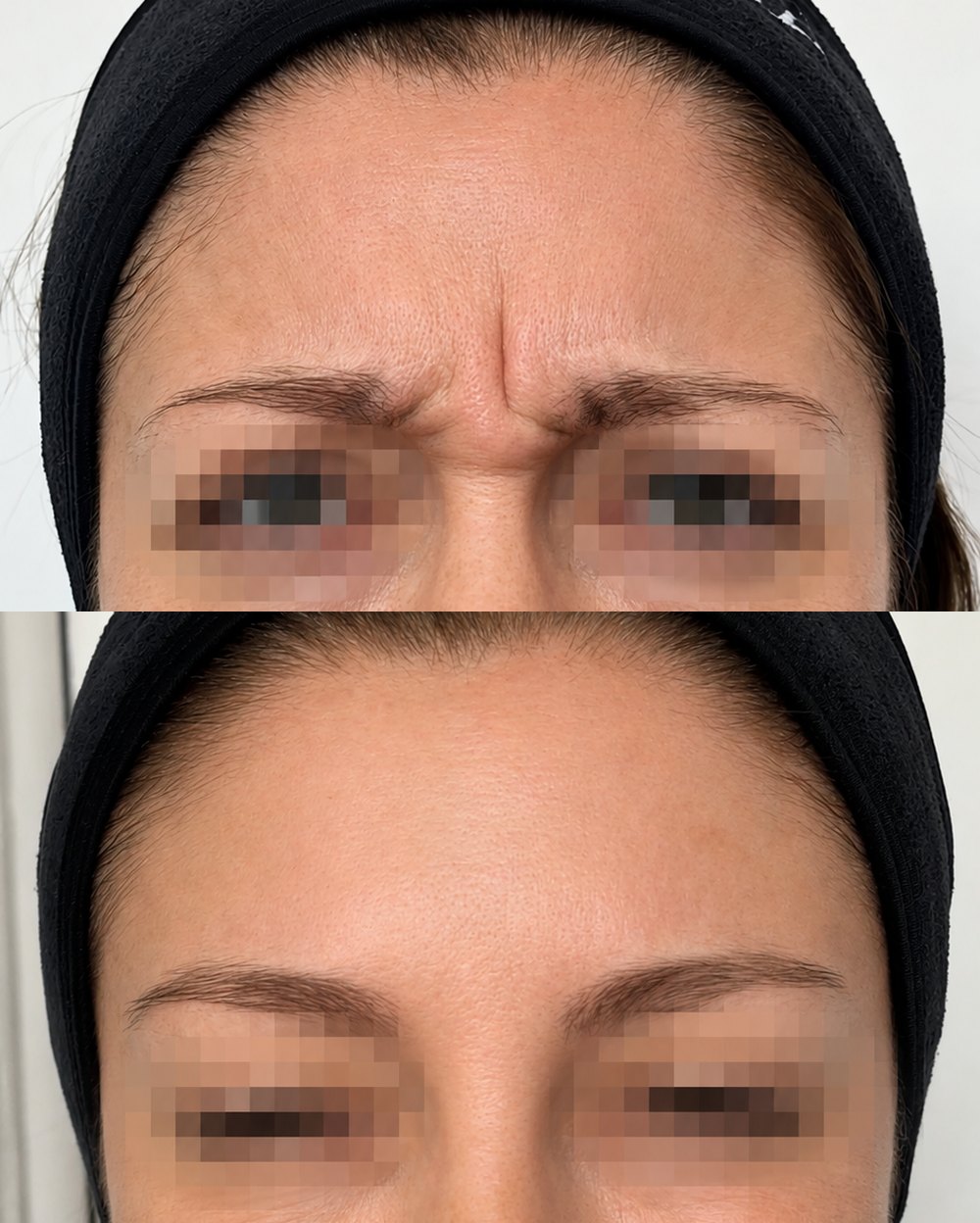 Antes y después de toxina botulínica · Dra. María-Francisca Ulloa